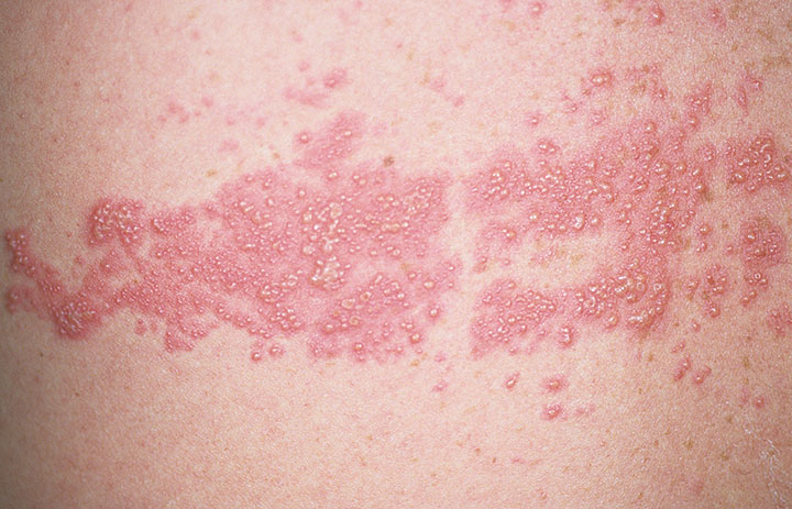 Herpes Zoster Shingles Stepwards