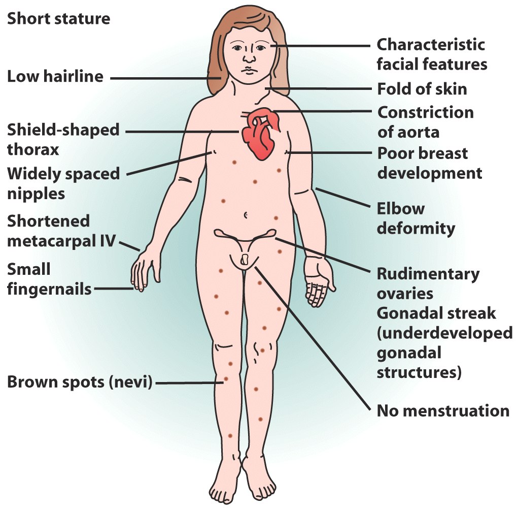 turner syndrome patient