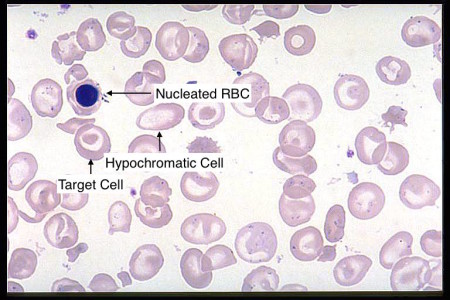 β-Thalassemia - Stepwards