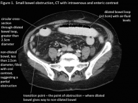 Condition Specific Radiology Small Bowel Obstruction Stepwards