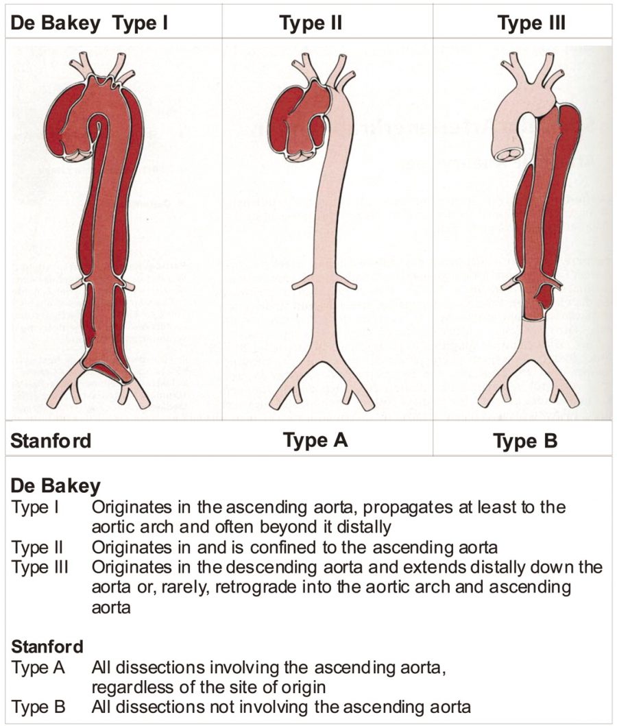 Aortic Dissection - Stepwards