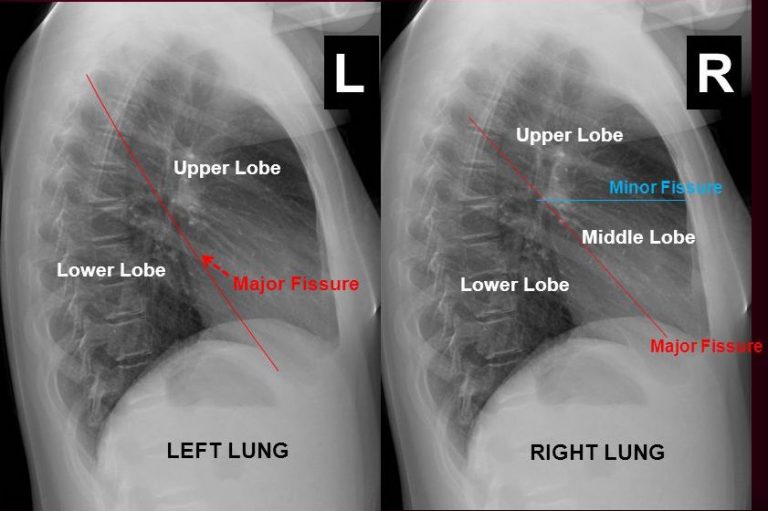 Interpreting A Chest X Ray Stepwards