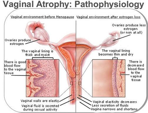 Post-Menopausal Bleeding and Arterial Thrombosis in Biological