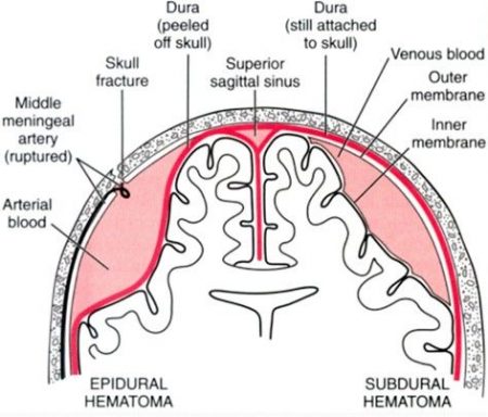 Condition Specific Radiology Epidural Hematoma Stepwards