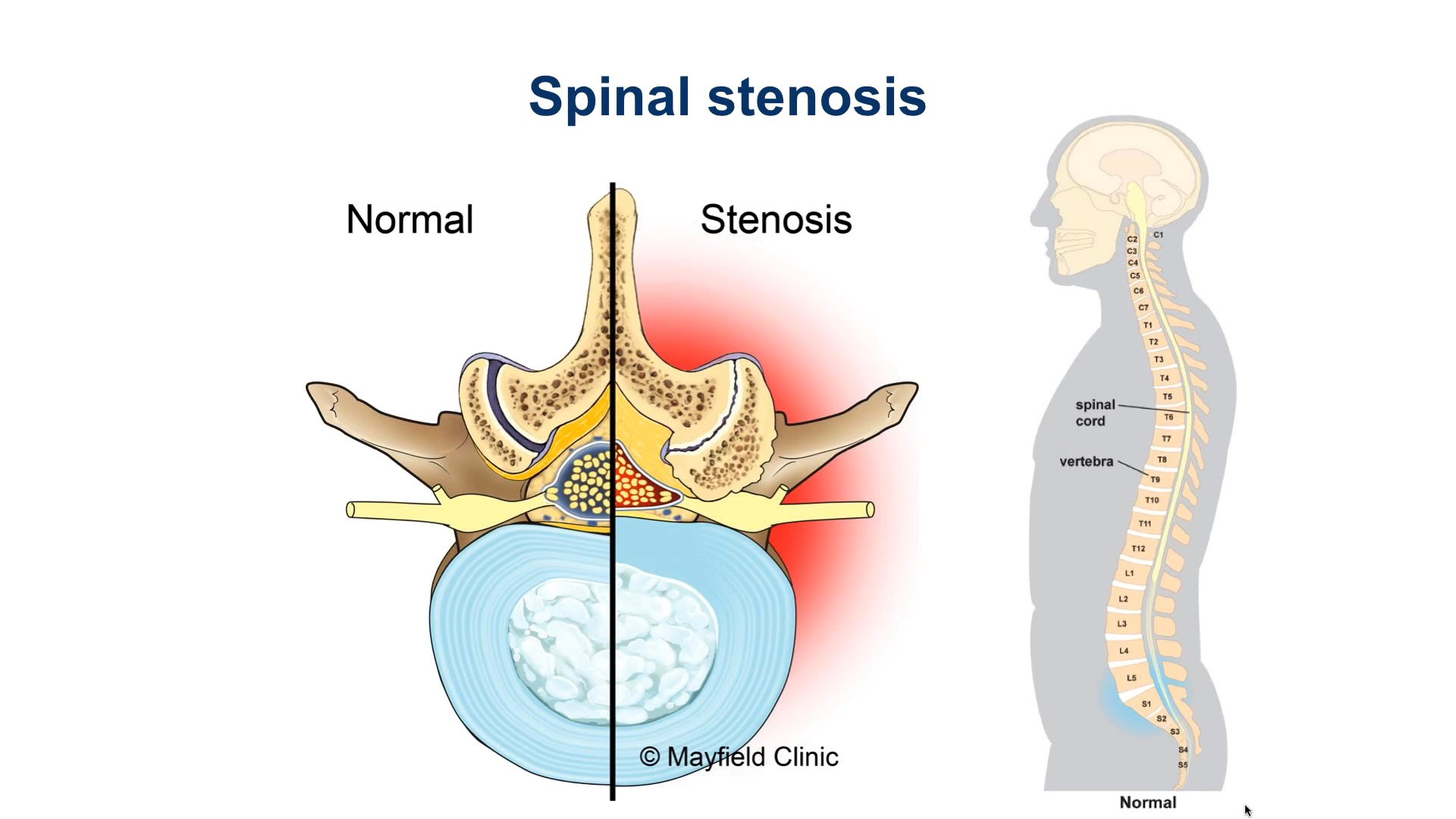 Lumbar spinal stenosis