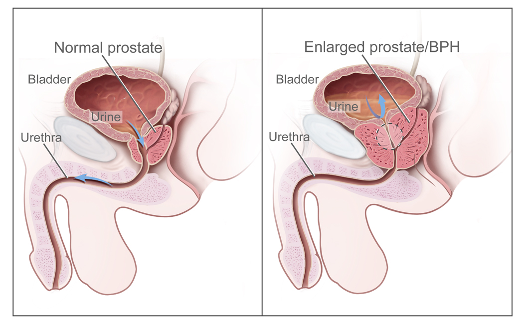 Patients with BPH can have urinary outlet obstruction. Medications like Flowmax can relax the smooth muscle of the prostate, reducing the pressure exerted on the urethra (source)