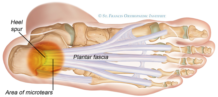 Micro-tears to the plantar fascia are thought to be responsible for this condition (source)