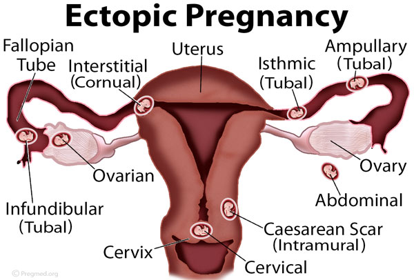 Ectopic Pregnancy Stepwards