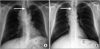 Radiological Anatomy Trachea Stepwards