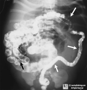 Meconium Ileus Stepwards