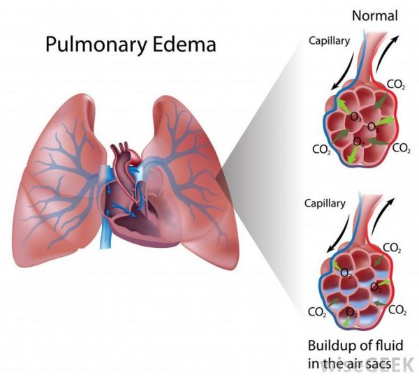 Condition Specific Radiology Alveolar Pulmonary Edema Stepwards