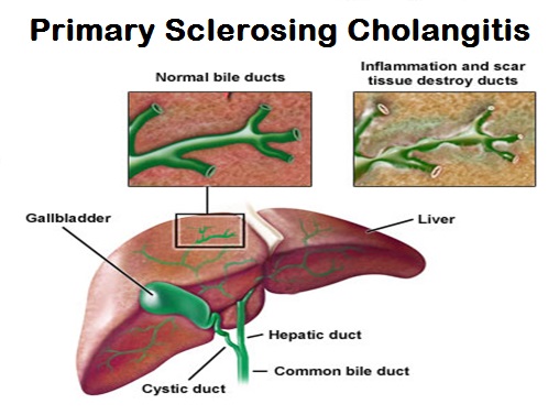sclerosing cholangitis