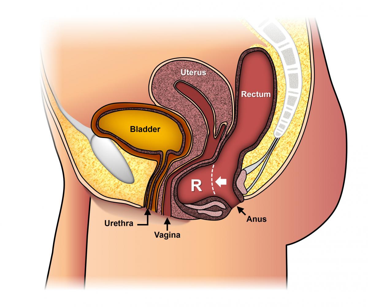 Rectocele Stepwards