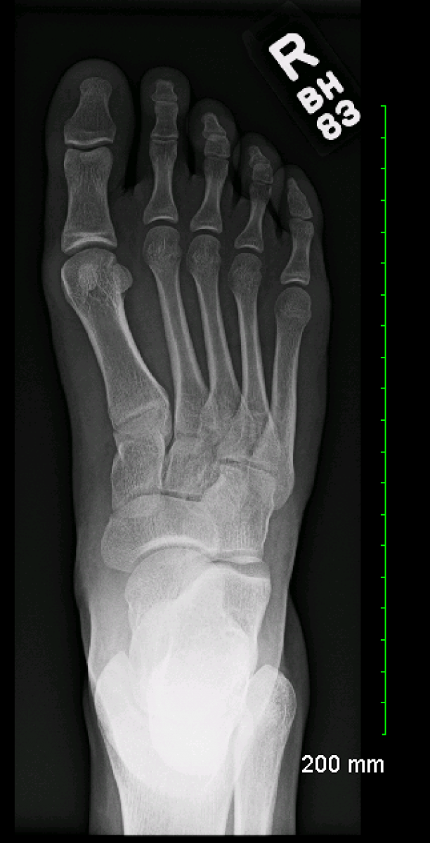 Archive Of Unremarkable Radiological Studies: Foot X-Ray - Stepwards