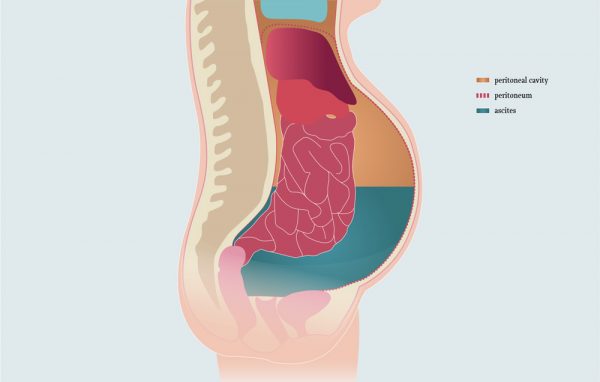 Condition Specific Radiology Ascites Stepwards