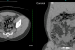 Condition Specific Radiology Appendicitis Stepwards