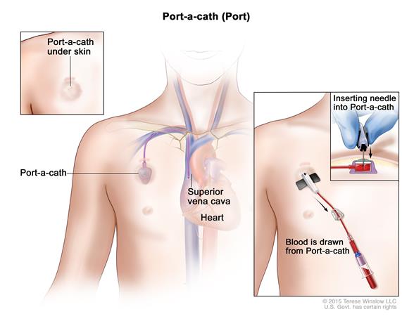 Medical Vascular Access Infusion Device Implantable Chemo Port
