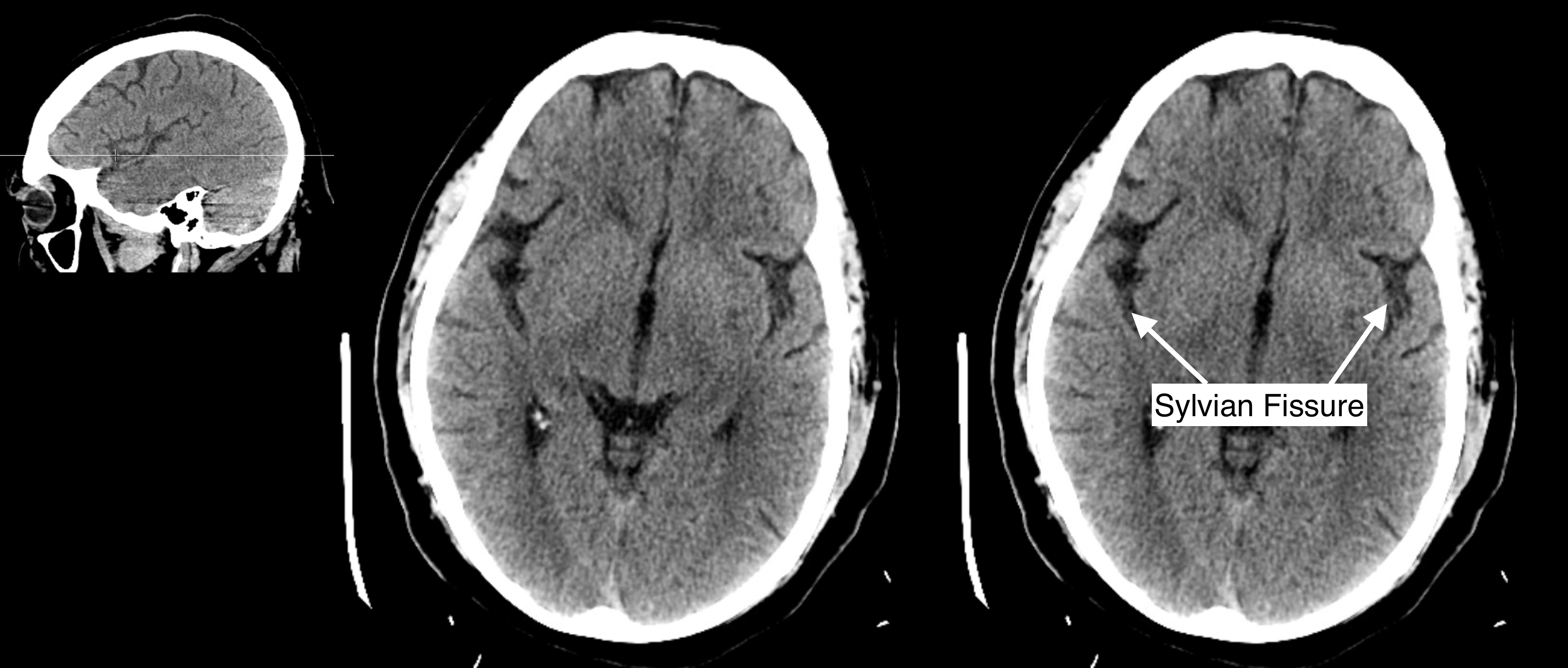 Radiological Anatomy: Sylvian Fissure - Stepwards