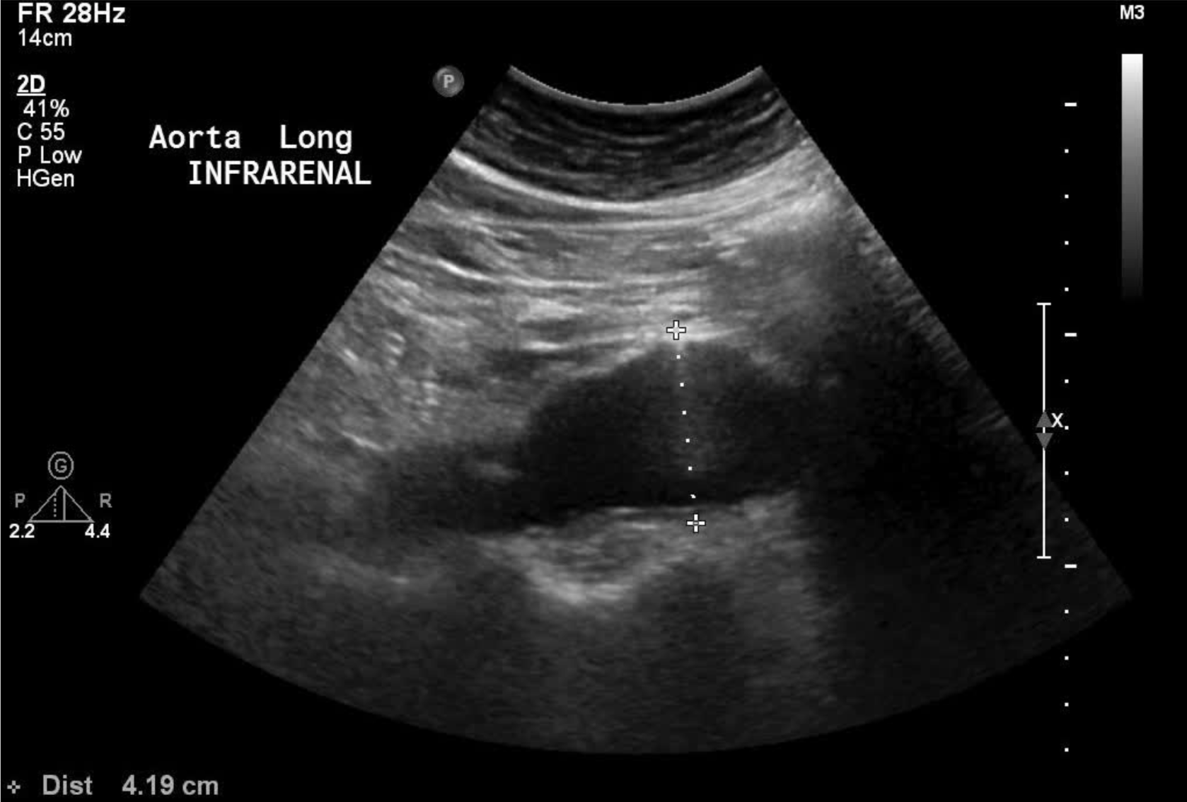 ruptured abdominal aortic aneurysm ultrasound