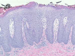 Psoriasis - Stepwards