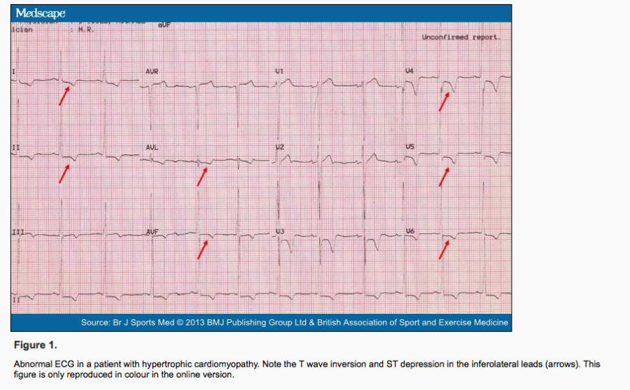 Hypertrophic Cardiomyopathy (HCOM/HCM) - Stepwards