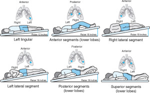 Bronchiectasis - Stepwards