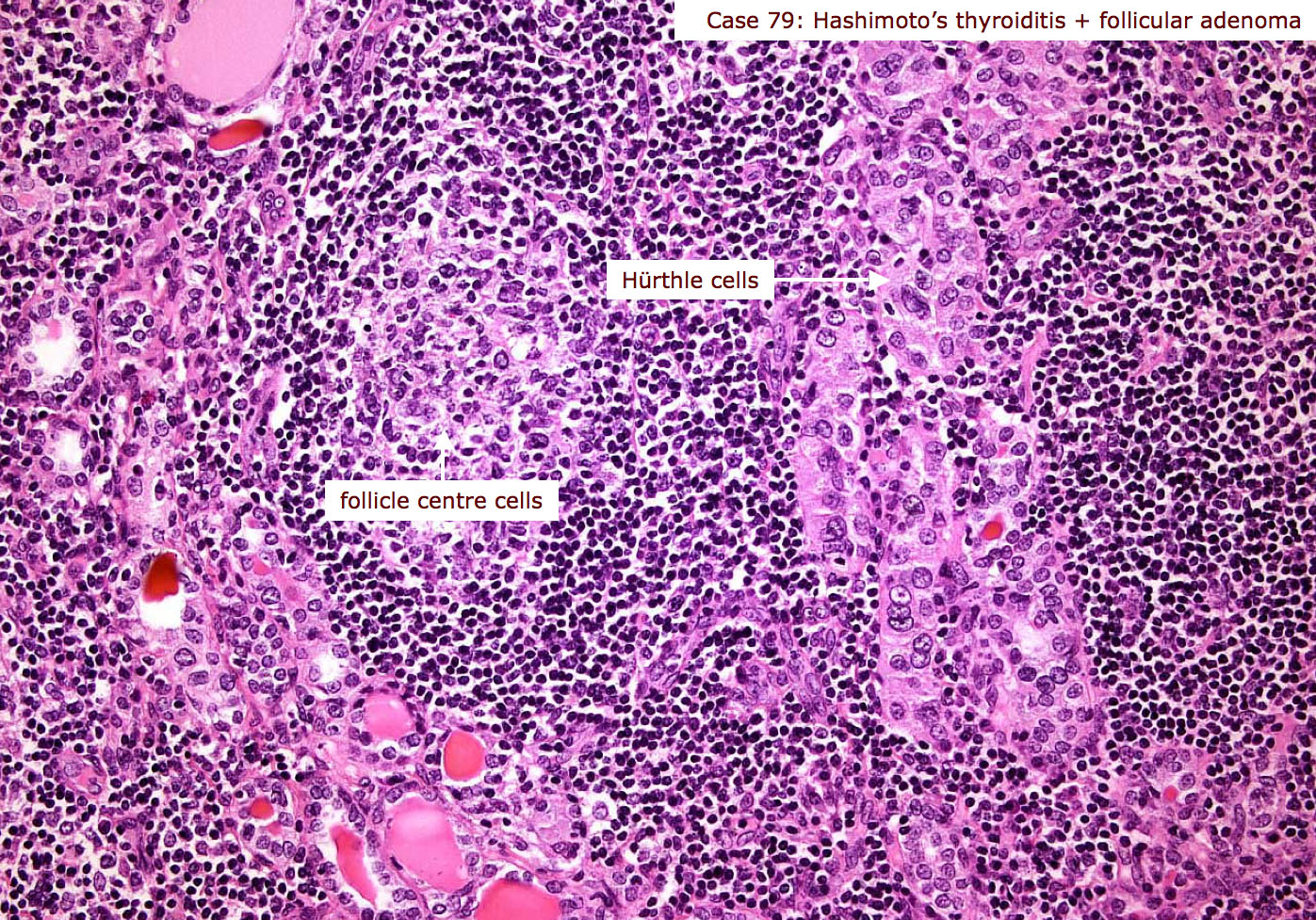 Hashimoto biopsy