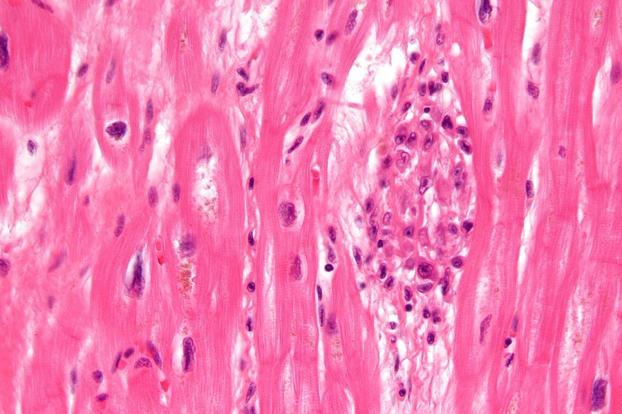 Acute Rheumatic Fever - Stepwards