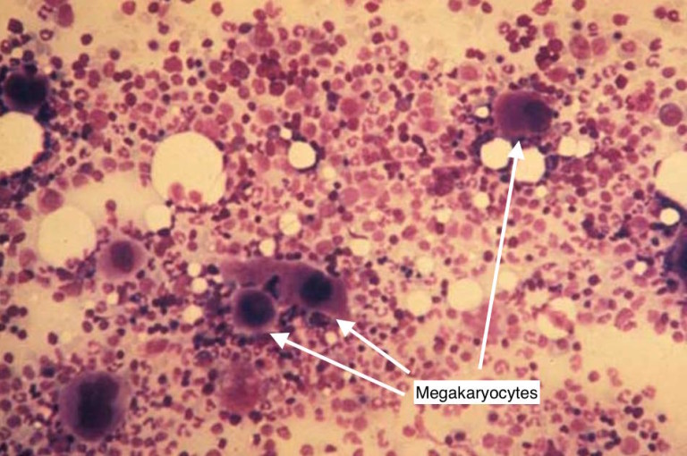 Immune Thrombocytopenic Purpura (ITP) - Stepwards