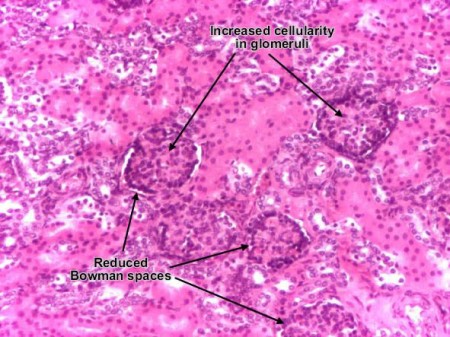 Acute Poststreptococcal Glomerulonephritis (PSGN) - Stepwards