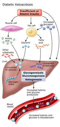 Diabetic Ketoacidosis (DKA) - Stepwards