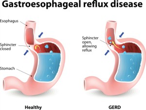 Esophagitis/Esophageal Reflux/Gastroesophageal Reflux Disease (GERD ...