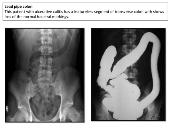 Ulcerative Colitis Stepwards