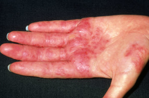 Contact Dermatitis - Stepwards