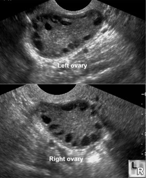 Polycystic Ovarian Syndrome (PCOS) - Stepwards