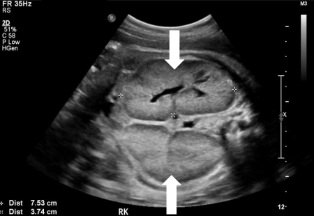 Autosomal recessive polycystic kidney disease (ARPKD) - Stepwards