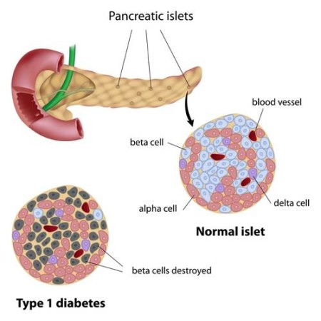 Diabetes Mellitus (Type 1) - Stepwards