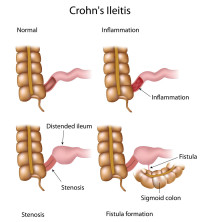 Crohn Disease - Stepwards