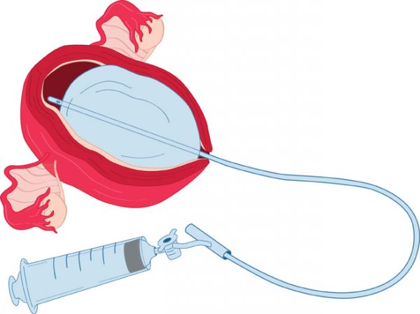 Postpartum hemorrhage (PPH) - Stepwards