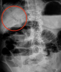 Interpreting An Abdominal X-Ray (KUB) - Stepwards