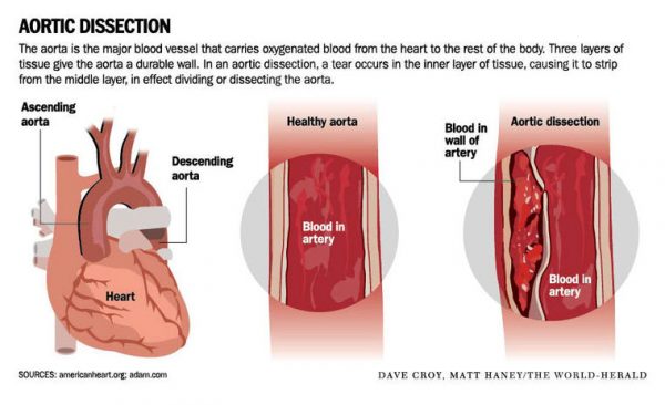 How Does Aortic Dissection Cause Pleural Effusion