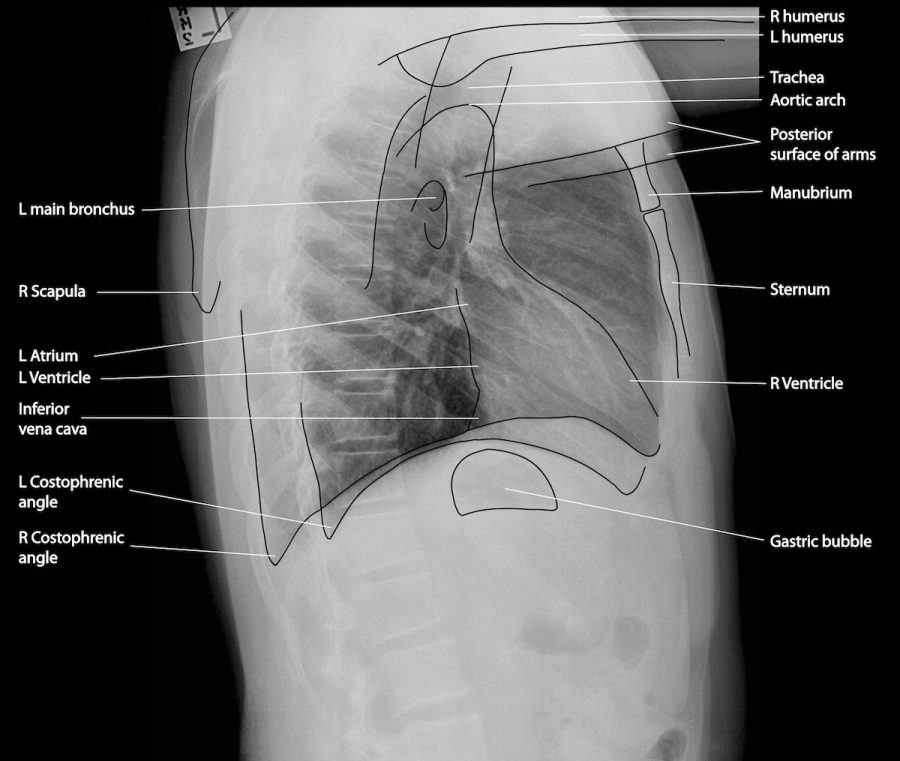 Interpreting A Chest X-Ray - Stepwards