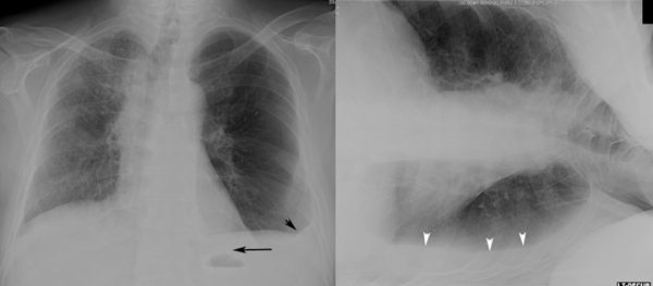 Interpreting A Chest X-ray - Stepwards