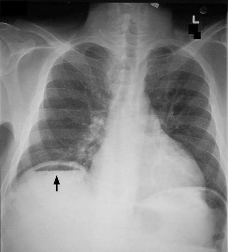 Interpreting An Abdominal X-Ray (KUB) - Stepwards