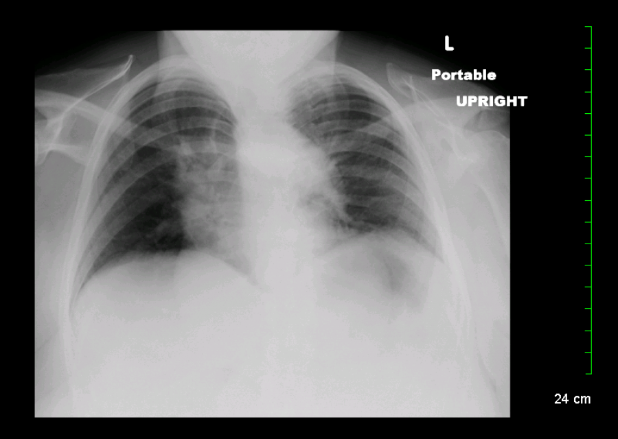 Interpreting A Chest XRay Stepwards