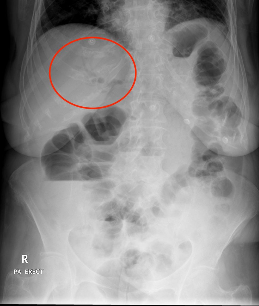 Interpreting An Abdominal X-Ray (KUB) - Stepwards