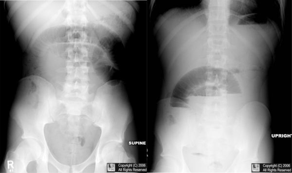 Interpreting An Abdominal X-Ray (KUB) - Stepwards