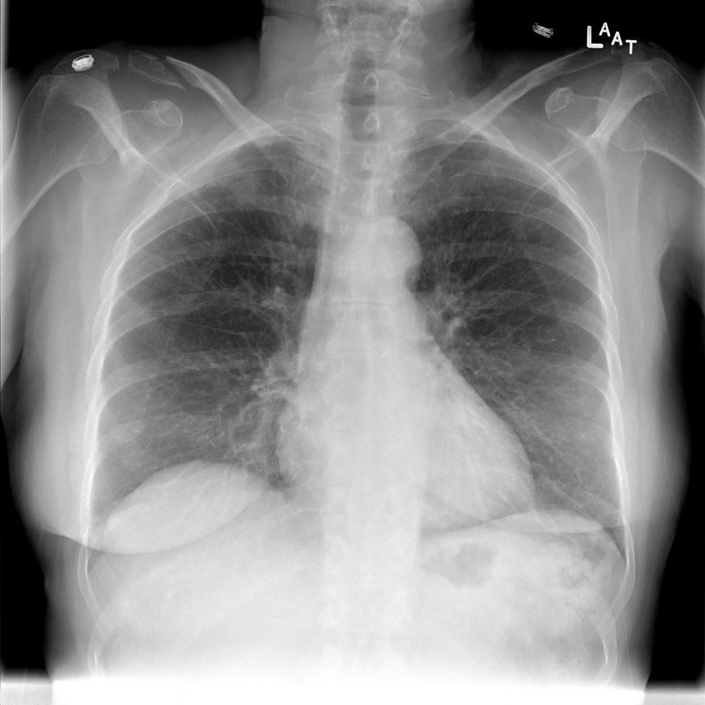 Interpreting A Chest X-Ray - Stepwards