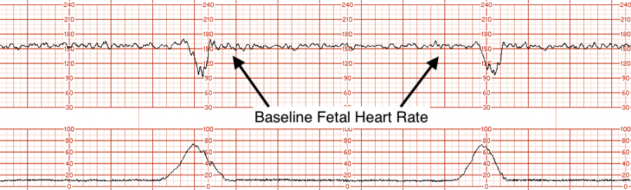 A Guide To Electronic Fetal Monitoring/Cardiotocogram - Stepwards