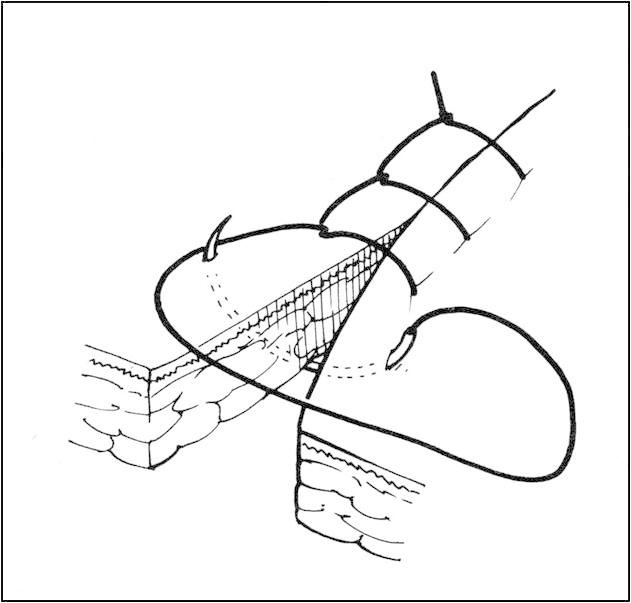 Running Locked Suture - Stepwards